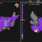 Nowoczesny system elektroanatomiczny 3D umożliwiający precyzyjne mapowanie struktur serca podczas zabiegów ablacji.